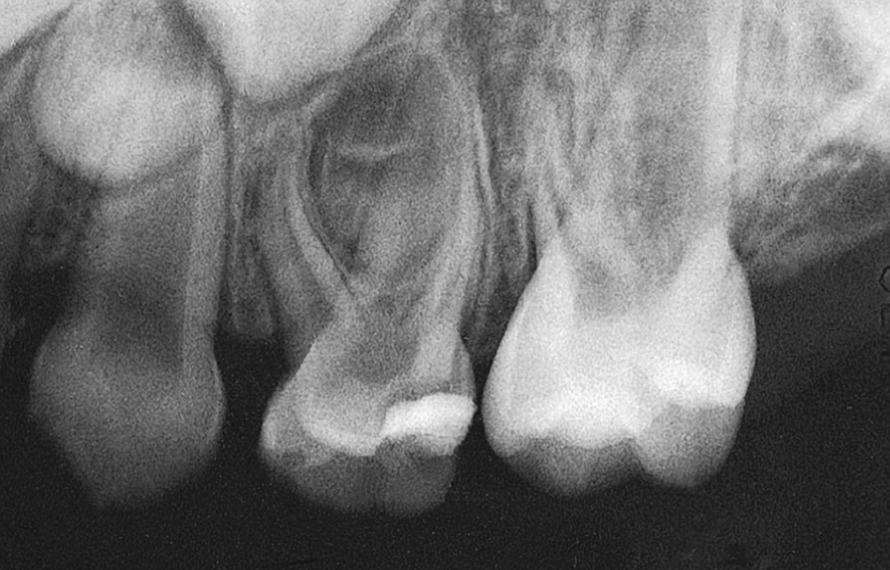 Radiograph of primary first molar with pulpitis displaying roots of the tooth that encircle the permanent tooth bud.