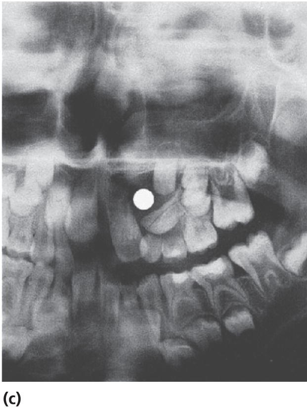 Radiograph of the left maxilla after the surgical removal of supernumerary teeth and residual cyst tissues.