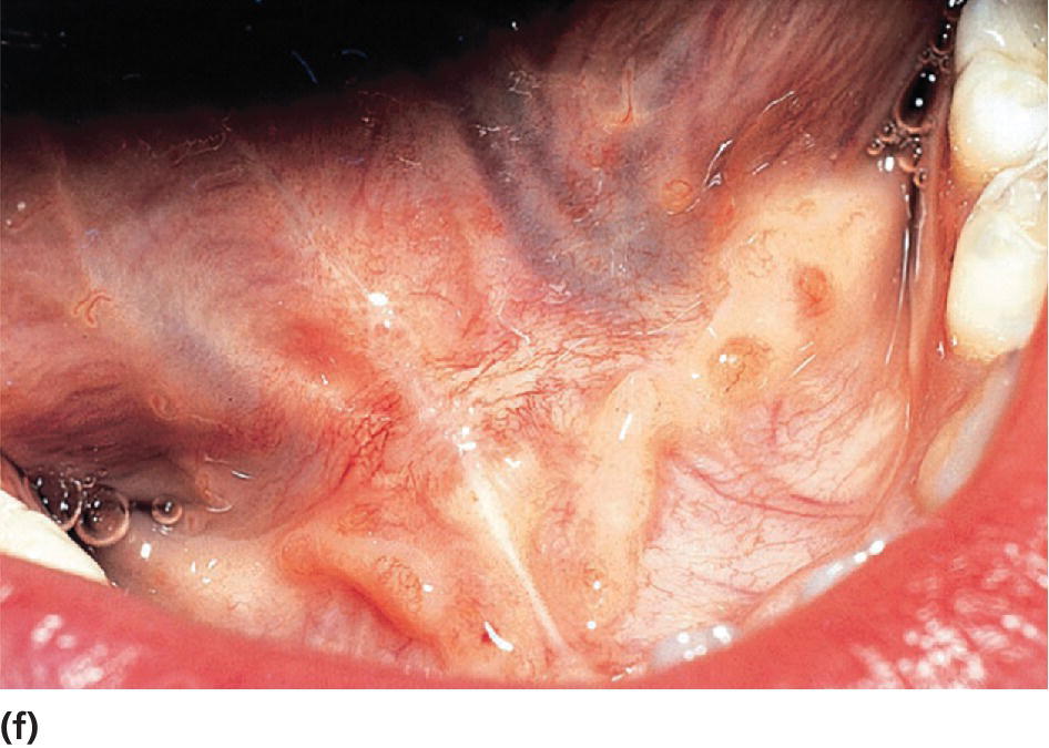 Photo displaying lingual frenuloplasty healing after 10 days.