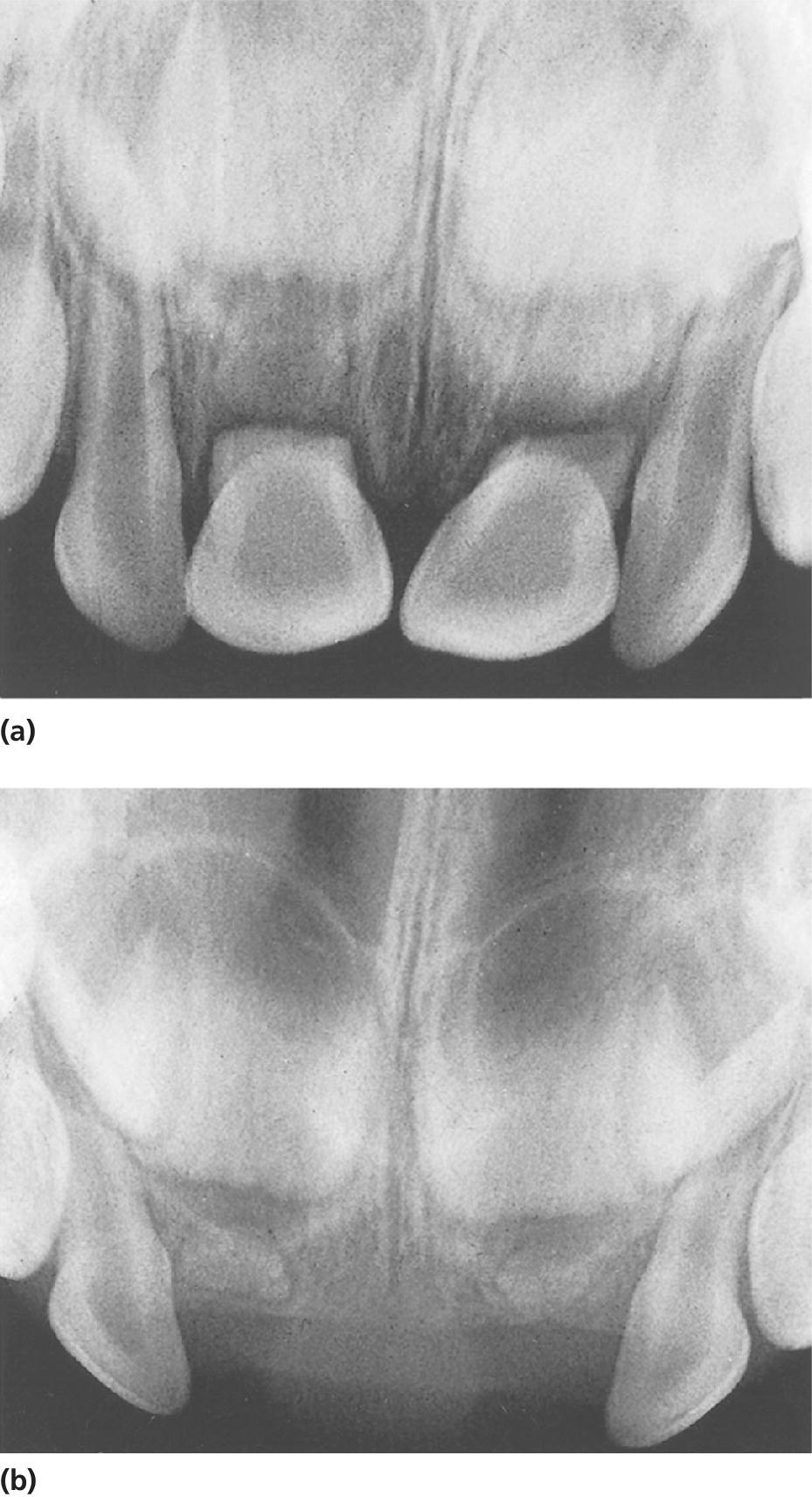 Radiographs displaying fractured roots of both central incisors with dislocation of the coronal fragments (left) and normal resorption of the apical fragments after removal of the coronal fragments (right).