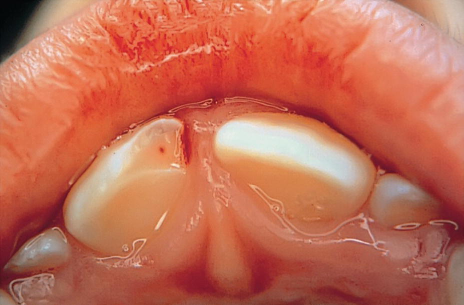 Photo displaying right central incisor with a small pulpal exposure, but with loosening and marked tenderness to percussion.