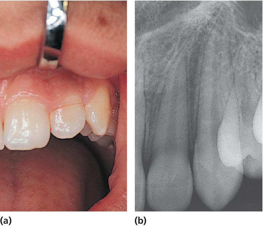 Photo of crown–root fracture of the left lateral incisor displaying the fracture line, which is located close to the gingival margin (left).; Radiograph of crown–root fracture of the left lateral incisor illustrating the position of the buccal part of the fracture, whereas the palatal part cannot be seen (right).