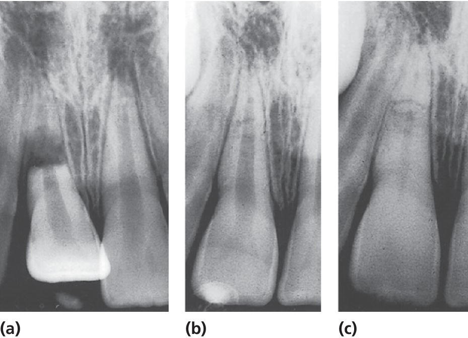 3 Radiographs of root fracture in right central incisor with severe dislocation of coronal fragment (a), best repositioning done in 1 hr (b) and normal findings in fracture area and partial pulp canal obliteration (c).