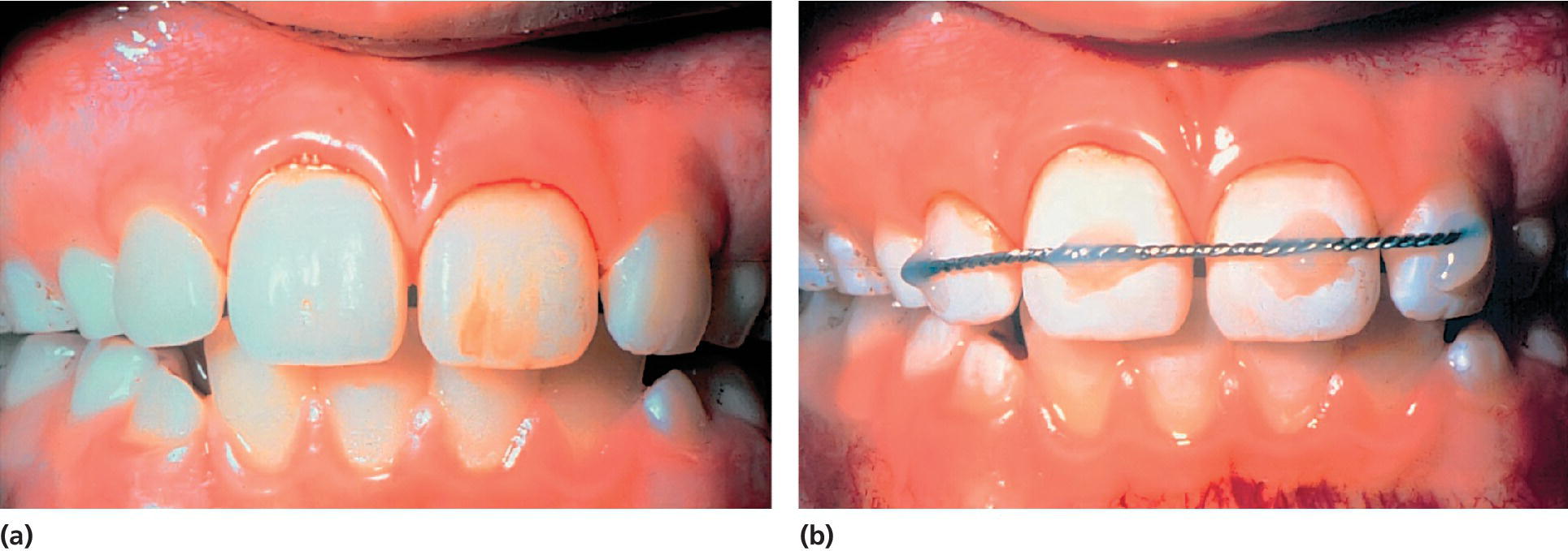 2 Photos displaying subluxation of both central incisors with mobility in horizontal and vertical directions (left) and stabilized teeth with orthodontic twisted wire, resin material and acid‐etch technique (right).