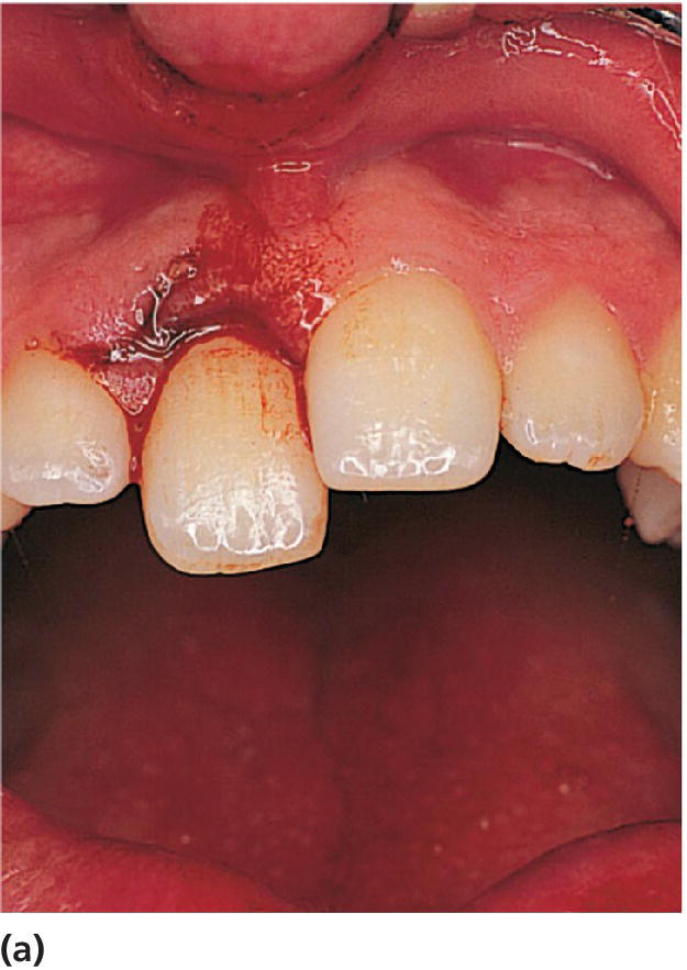 Photo illustrating extrusive luxation of the right central incisor where the tooth appears elongated and is also very mobile.