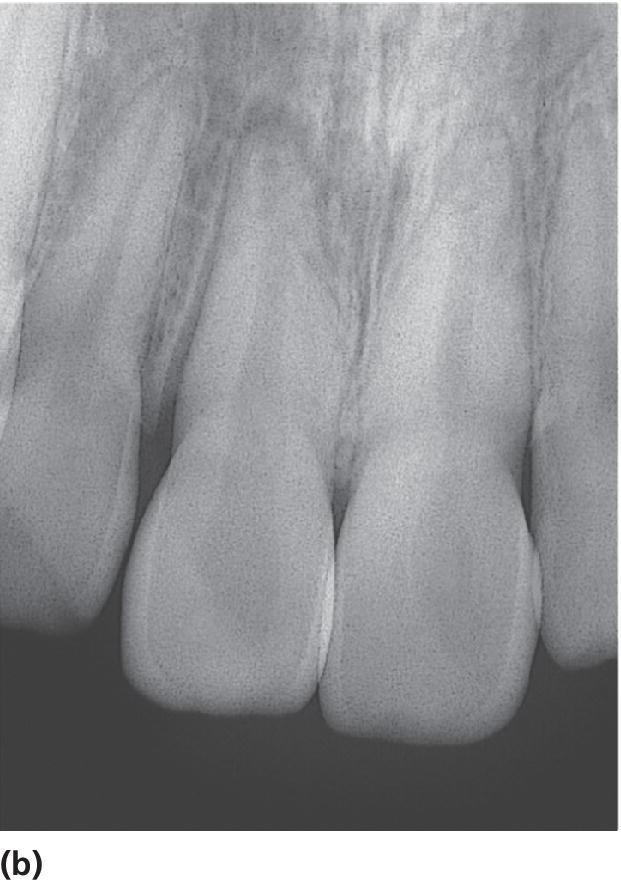 Radiographs presenting increased periodontal width apically (b) and optimal position of the tooth in its socket, after repositioning (c).