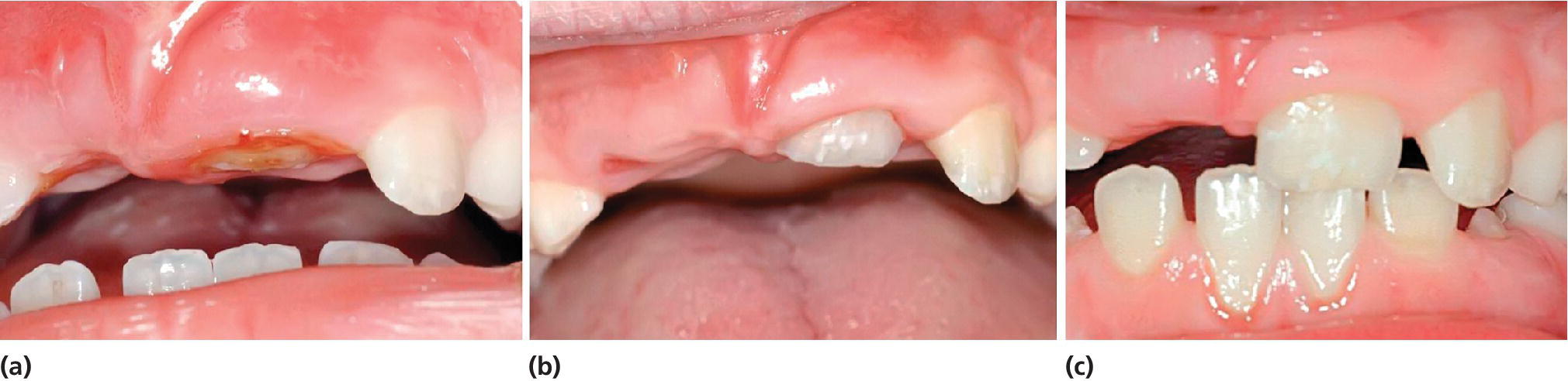 3 Photos of complete intrusion of left central incisor in 9‐year‐old boy with incisal edge visible 5 days after accident (a), partial reeruption evident 1 month later (b) and complete reeruption 10 months after trauma (c).