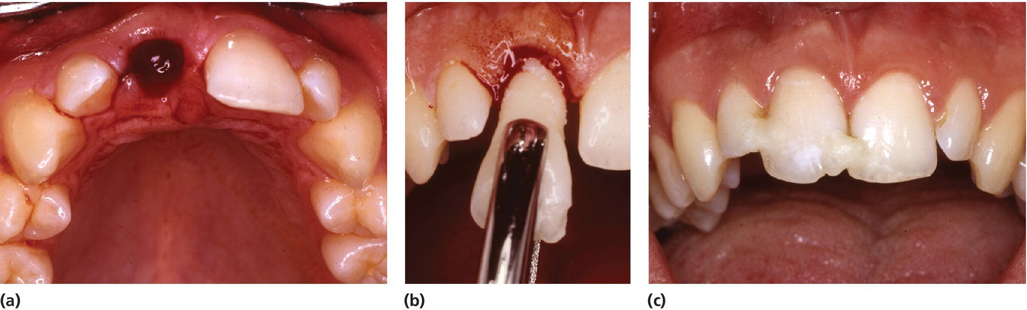 Photos displaying 10‐year‐old girl with avulsion of left central incisor after skiing accident (left) and avulsed tooth is replaced in socket with gentle finger pressure (center) and a splint is applied (right).