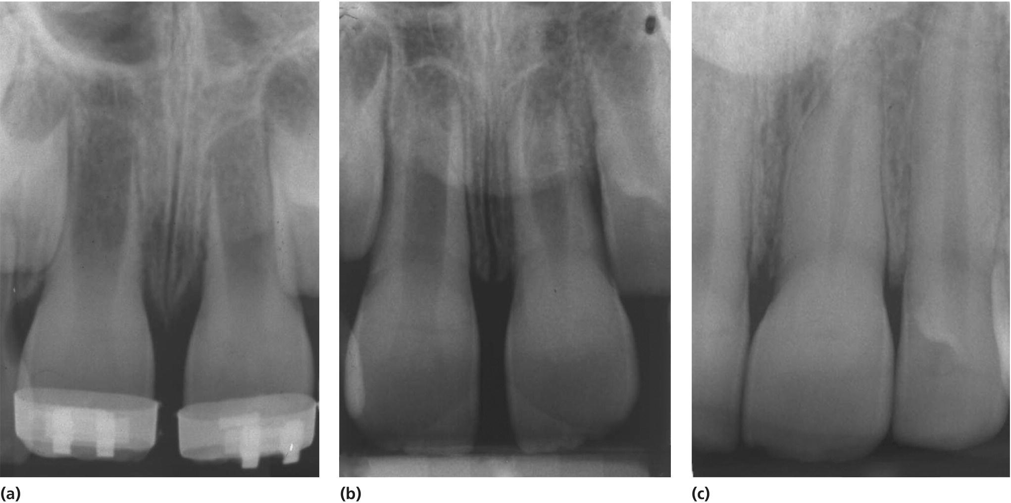 3 Radiographs displaying successful replantation of the left central incisor in a 7‐year‐old boy 6 days (a) and 1 year after replantation (b) and 4 years after the accident with completed root formation (c).