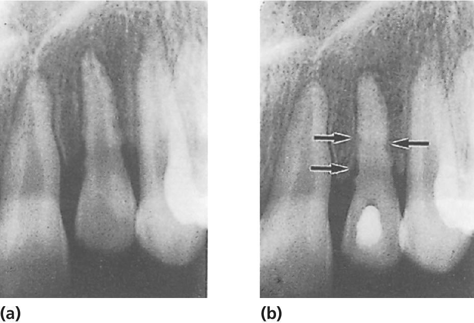 2 Radiographs of external infection‐related root resorption along root surface of an intruded lateral incisor 6 weeks after injury (a) and during endodontic treatment with defects seen on the root surface (b).