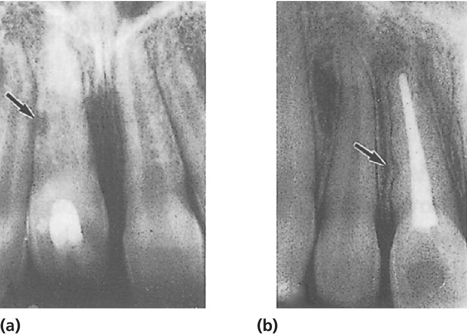 2 Radiographs of external infection‐related root resorption after intrusive luxation of a right central incisor with arrow for area of resorption 6 weeks after injury (a) and persistent defect 2 years later (b).