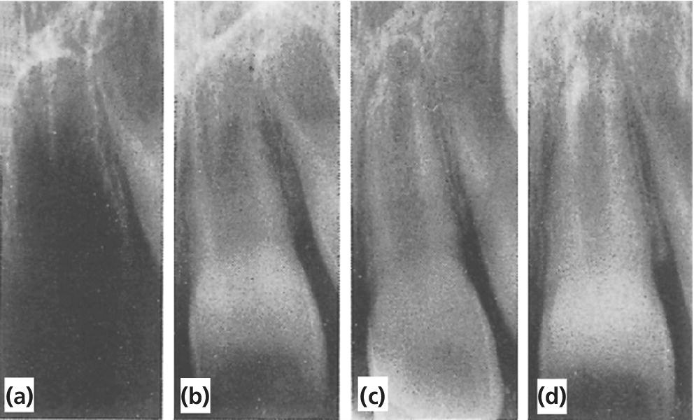 4 Radiographs a left central incisor before (a), 12 days (b), and 6 months (c) after replantation and 1 year (d) after injury displaying continued root development and narrowing of pulp canal.