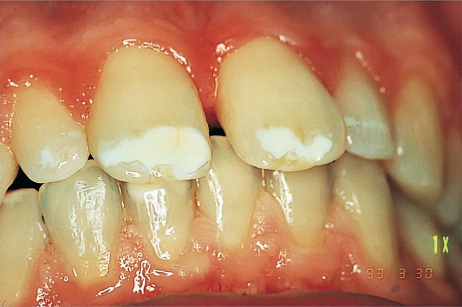 Photo of a human dentition with discoloration and enamel hypomineralization in a 14‐year‐old boy with cystic fibrosis.