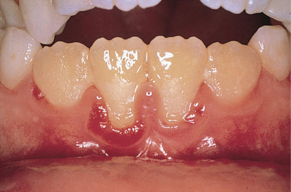 Photo of the dentition a 12‐year‐old boy with immunoglobulin A and G deficiency
exhibiting ulceration of the marginal gingiva.