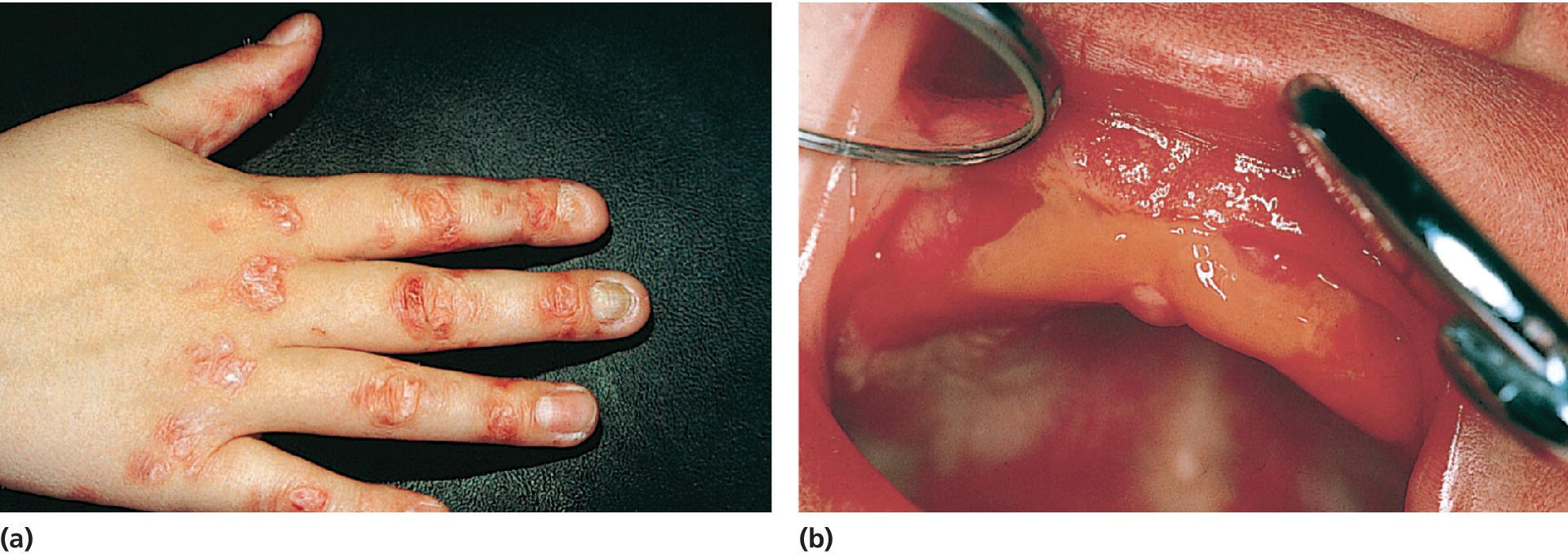 Left: Photo of a blistering of hand and fingers in a 10‐year old boy with dystrophic epidermolysis bullosa. Right: Photo of oral blistering and scarring in a 1‐month‐old boy with dystrophic epidermolysis bullosa.