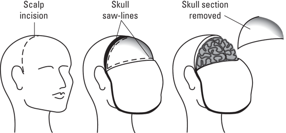 Sketches depicting Scalp incision, skull saw-lines, and skull section removed.