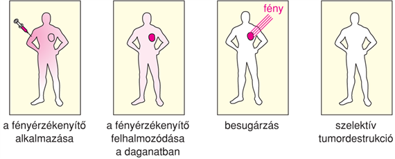 IX/2.2. Fotodinamikus terápia