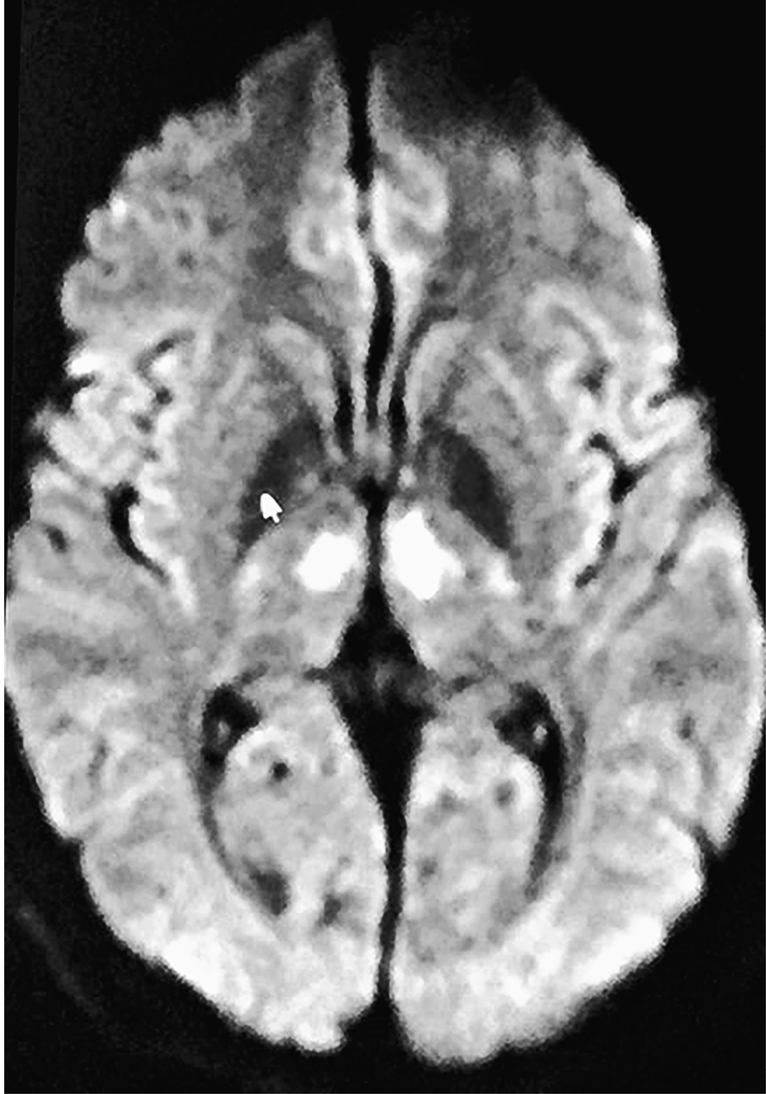 Magnetic resonance image (MRI) of Dave’s brain on June 10, 2015. The clear white areas near the middle of the brain are infarcts (dead tissue) in both the right and left sides of the medial thalamus. The thalamus is the brain’s major relay center, through which run vital connections between many different parts of the brain. Dave’s brain had, in effect, two big holes of dead neurons at its center.