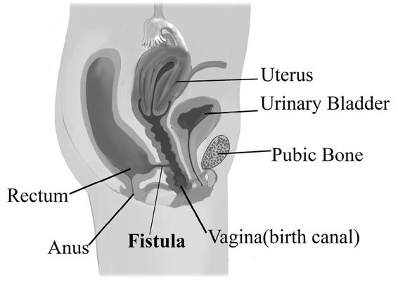 fig%2011-5--female%20human%20repro%20Fistula.jpg