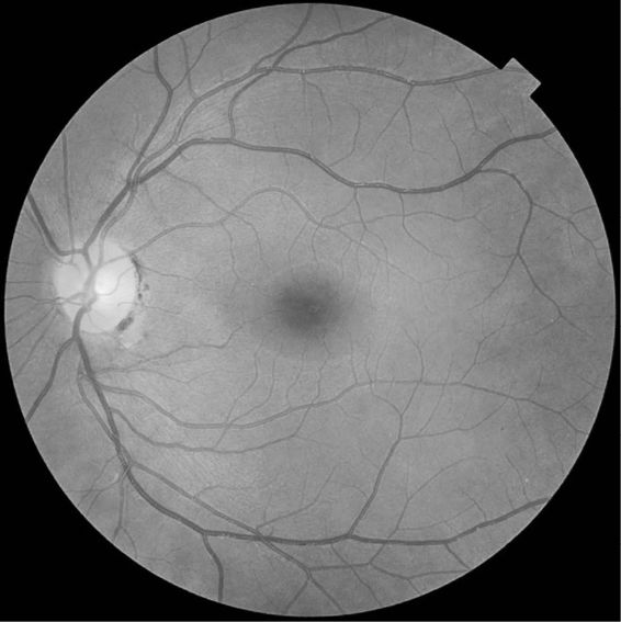 fig%2022-2--opthalmoscope-Fundus_photograph_of_normal_left_eye.jpg