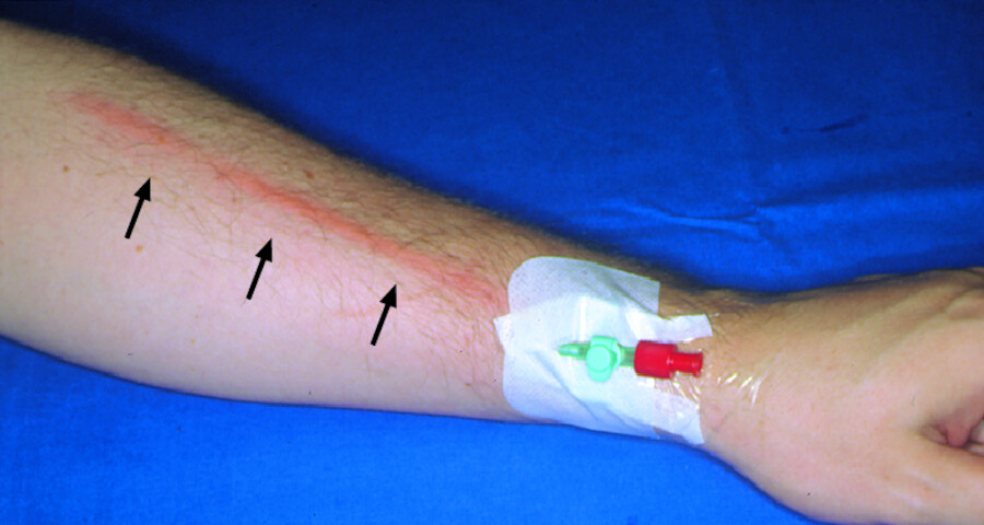 Thrombophlebitis. Durch eine Venenkanüle entstandene Thrombophlebitis.