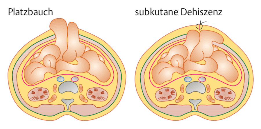 Platzbauch und subkutane Dehiszenz. Äußere Faszie (blau) und das Peritoneum (rot) sind hervorgehoben.