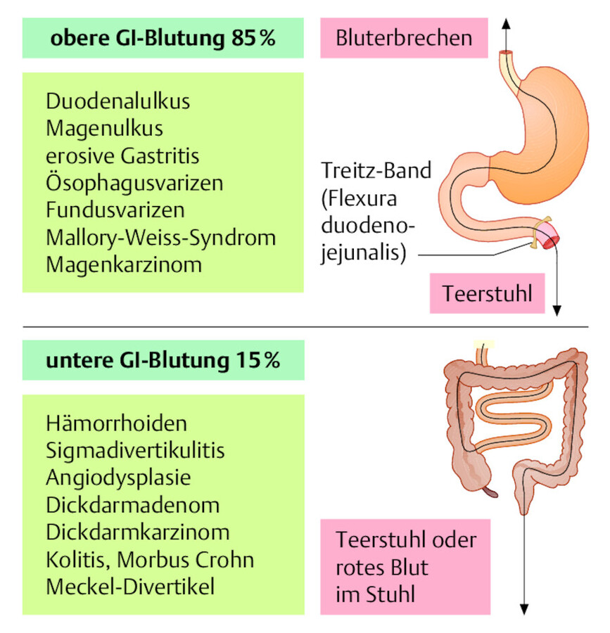 Gastrointestinale Blutung. Die wichtigsten Blutungsquellen bei oberer und unterer GI-Blutung entsprechend ihrer klinischen Häufigkeit.