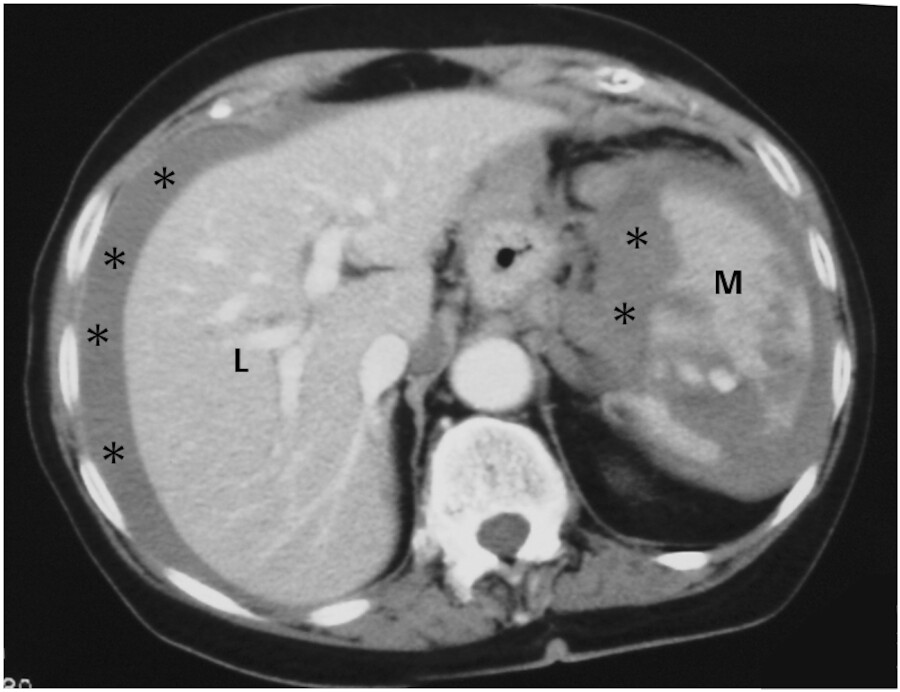 Intraabdominelle Blutung. Das CT zeigt freies Blut (*) in der Bauchhöhle. Ursache ist eine Milzverletzung (M) durch ein stumpfes Bauchtrauma (L: Leber).