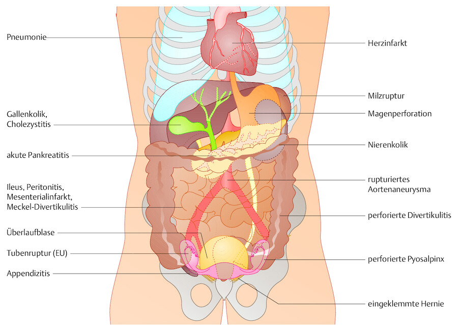 Akutes Abdomen. Die wichtigsten ursächlichen Krankheitsbilder.