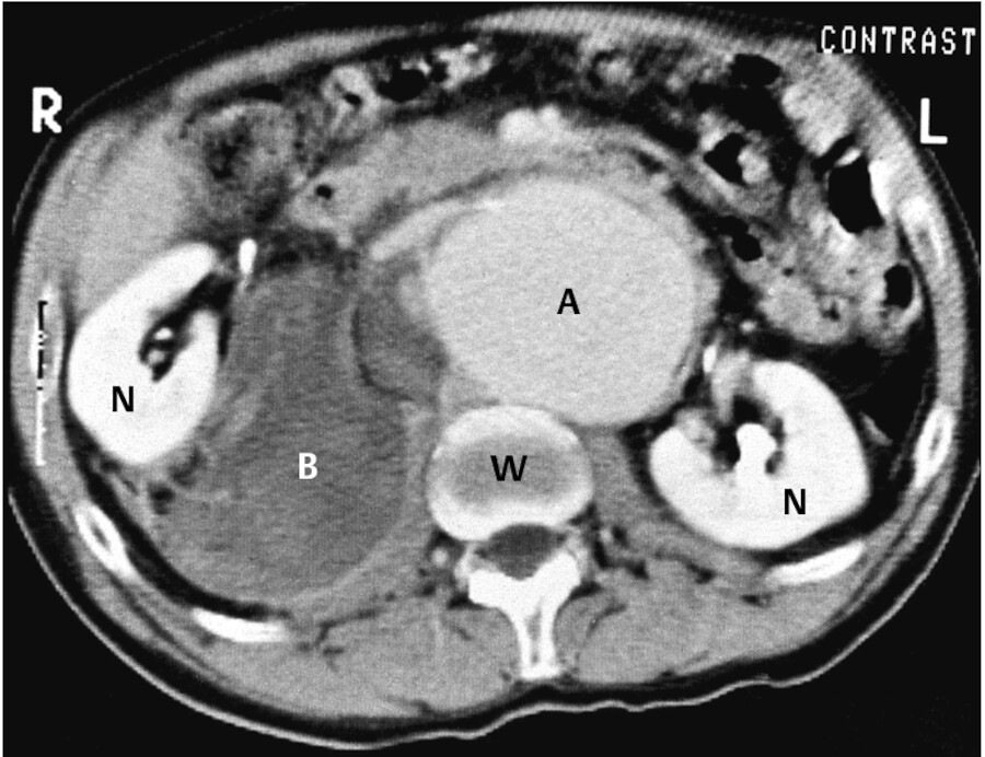 Akutes Abdomen. Das CT zeigt ein rupturiertes Aortenaneurysma, A: erweiterte Aorta, B: Blutung, N: Niere, W: Wirbelkörper.