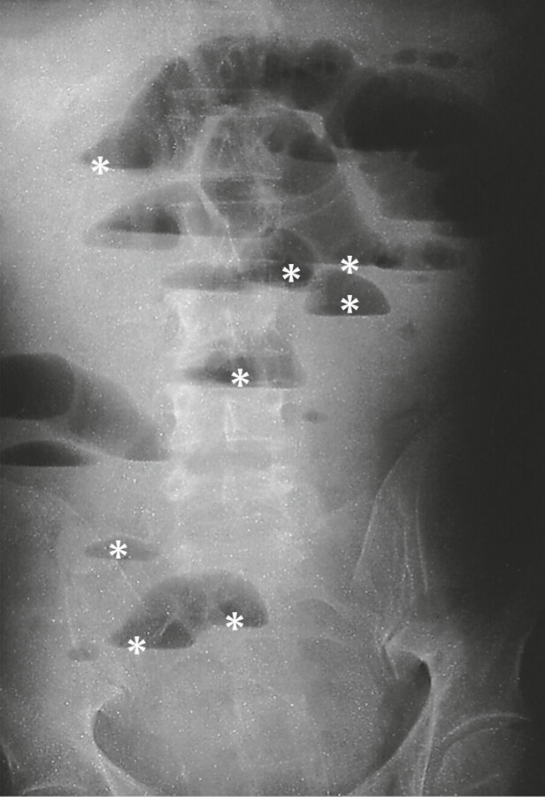 Ileus. Typisches Röntgenbild ohne Kontrastmittel (Abdomenleeraufnahme im Stehen). Einige der horizontalen Spiegelbildungen (*) und stehenden luftgefüllten Darmschlingen (Pfeile) sind hervorgehoben.