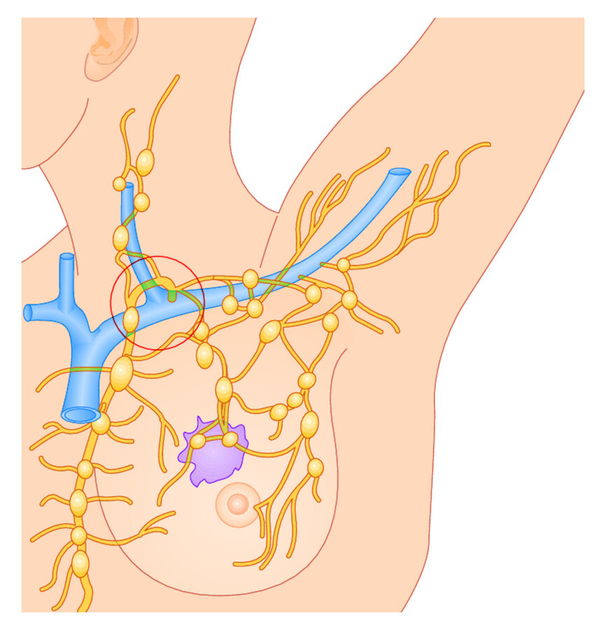 Lymphogene Metastasierung. Beispiel Mammakarzinom. Die großen Lymphbahnen münden über den Ductus thoracicus in das Venensystem (Kreis). So kann über die Lymphbahnen eine hämatogene Metastasierung erfo