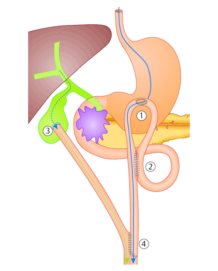 Palliative Bypassoperation bei einem Pankreaskopfkarzinom. Die Enge im Duodenum wird durch Gastroenterostomie = GE (1) umgangen, Speisepassage blau. Zusätzliche Braun-Anastomose (2) für den Abfluss de