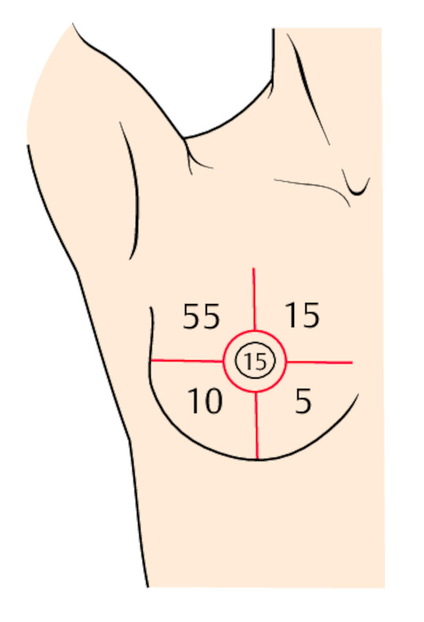 Mammakarzinom. Lokalisation der Häufigkeit in Prozent.