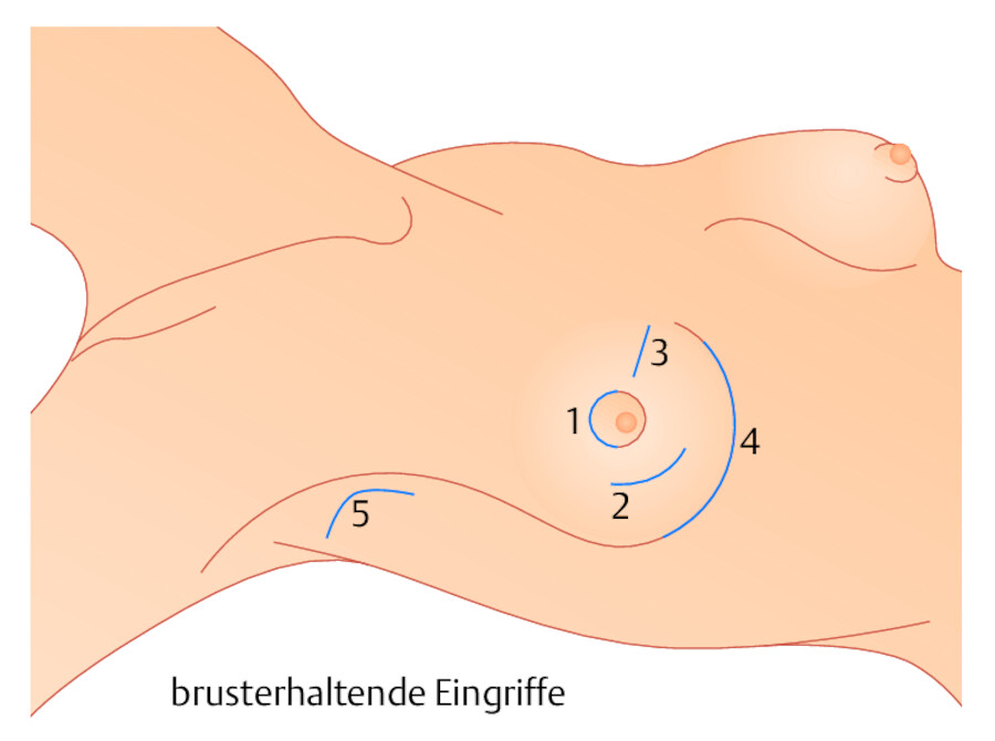 Schnittführung bei brusterhaltenden Eingriffen. Je nach Behandlungsziel erfolgen verschiedene Schnittführungen: periarioläre Inzision (1) und konzentrisch dazu verlaufender semizirkuärer Schnitt (2), 