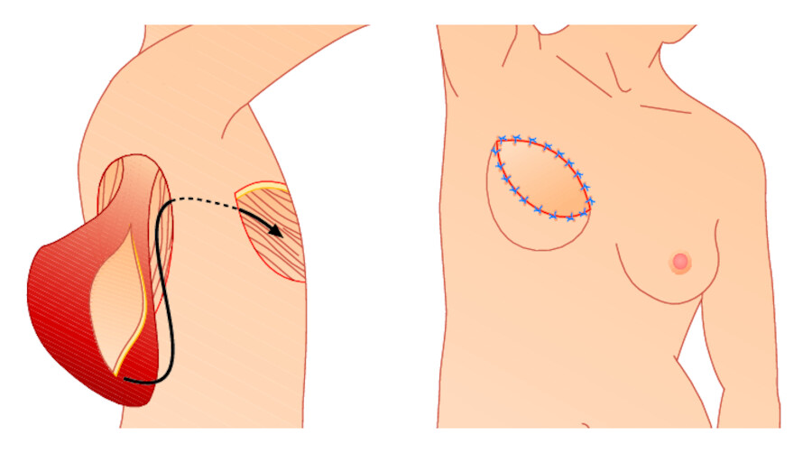 Latissimus-dorsi-Schwenklappen.