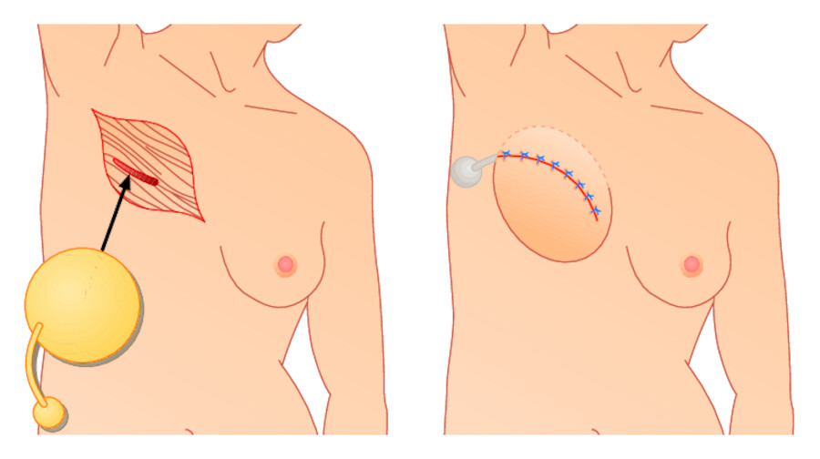 Brustaufbau mittels Expandertechnik und späterer Prothesenimplantation.