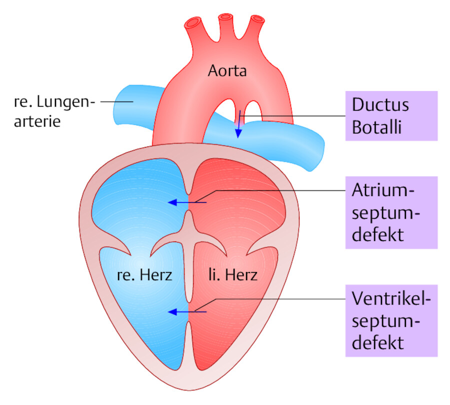 Links-rechts-Shunts. Die angeborenen Kurzschlussverbindungen zwischen großem und kleinem Kreislauf treten bevorzugt in Höhe der Vorhöfe (ASD = Atriumseptumdefekt, der Herzkammern (VSD = Ventrikelseptu