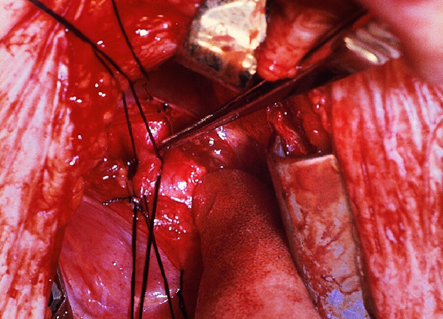 Ductus Botalli. Die Verbindung zwischen Aorta und Lungenarterie wird mit Faden unterbunden (Duktusligatur).