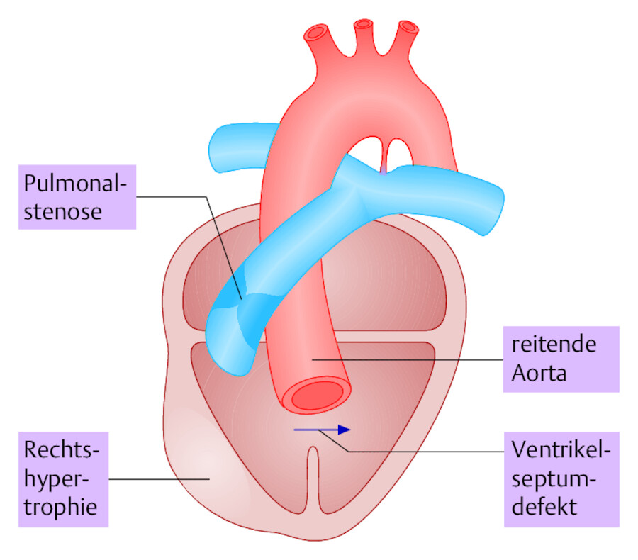 Fallot-Tetralogie. Schematische Darstellung der 4 Fehlbildungen.