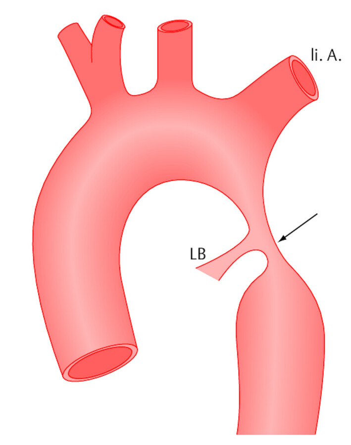 Aortenisthmusstenose. Angeborene Verengung (Pfeil) der Hauptschlagader in Höhe des Ligamentum Botalli (LB) unterhalb des Abgangs der linken Armarterie (li. A.).