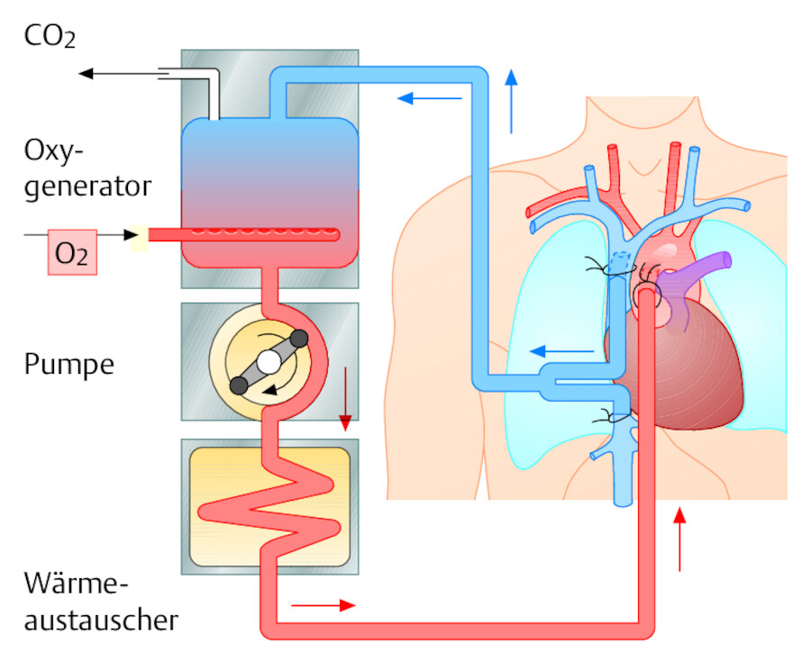 Extrakorporaler Kreislauf. Das venöse (zum Herzen strömende) Blut wird von den Hohlvenen in die HLM geleitet und von dort wieder in die Aorta ascendens zurückgeführt.