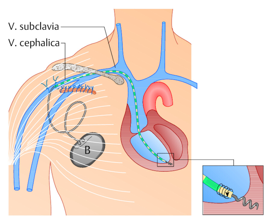 Transvenöser Herzschrittmacher. Von einem Schnitt unterhalb des Schlüsselbeins wird die Batterie (B) im Unterhautfettgewebe positioniert. Das Elektrodenkabel führt man über die V. cephalica unter Rönt