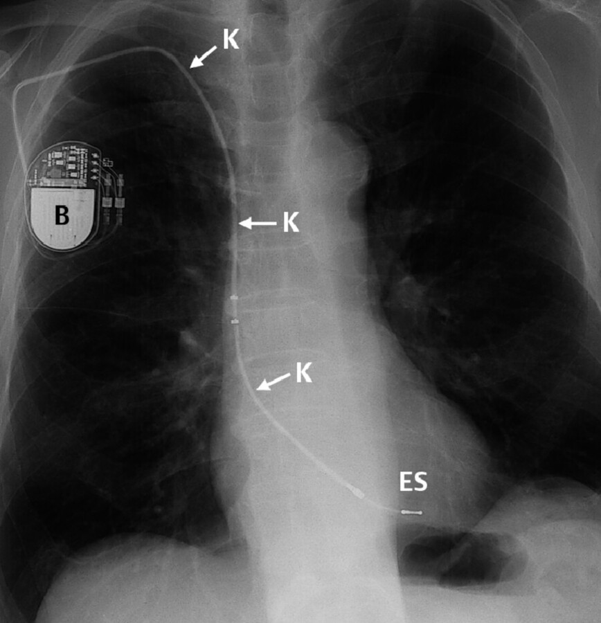 Herzschrittmacher. Auf dem Röntgenbild sind deutlich die Batterie (B) und das Kabel (K) zu erkennen. Die Elektrodenspitze (ES) liegt im Herzen.