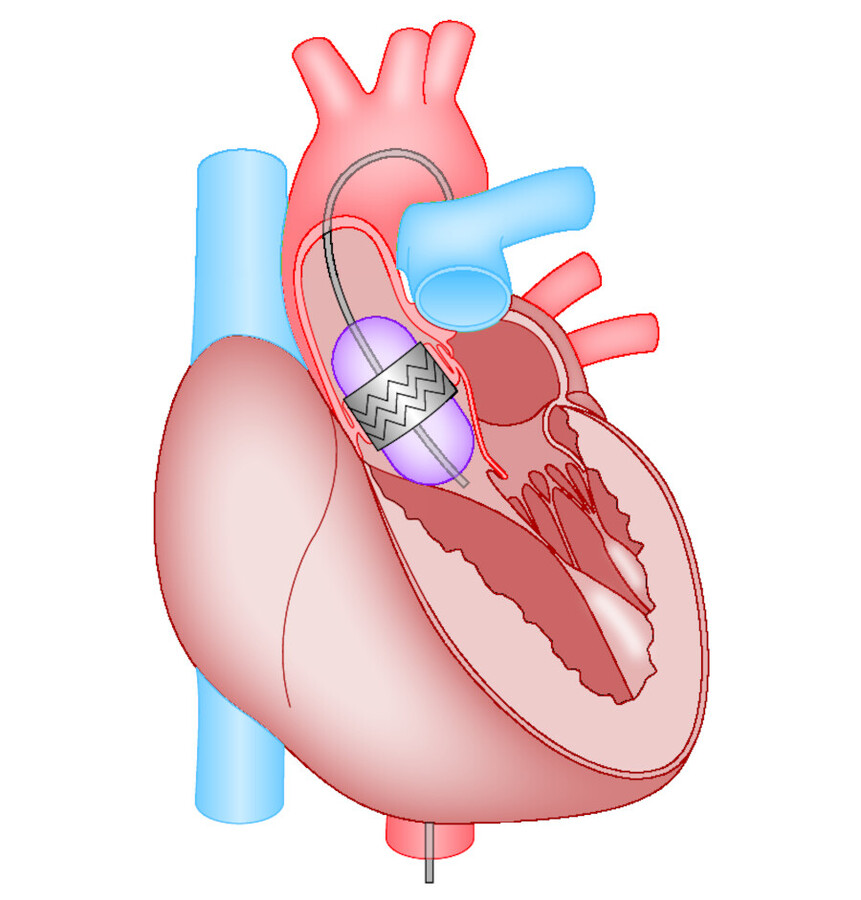 Endovaskulärer Herzklappenersatz. Die Herzklappe ist in einen Katheter eingebaut, der von der Leistenarterie bis in die Aortenklappenposition vorgeschoben wird. Dort erfolgen Freisetzung und Fixierung