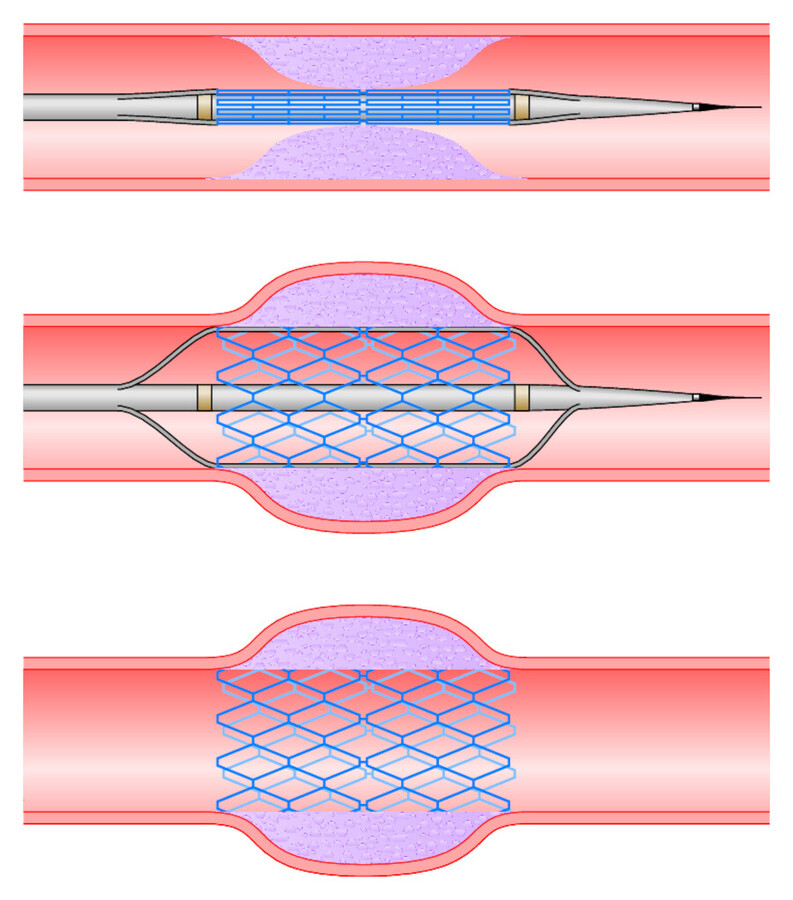 PTCA. Aufdehnung einer verengten Herzkranzarterie und Einbringen eines Stents.