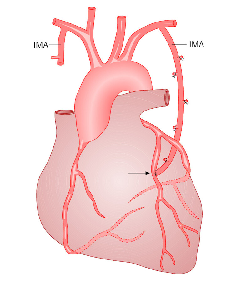 Mammaria-Bypass. Der periphere Anteil der linken A. mammaria interna (IMA) wurde mit einer Herzkranzarterie anastomosiert (Pfeil).