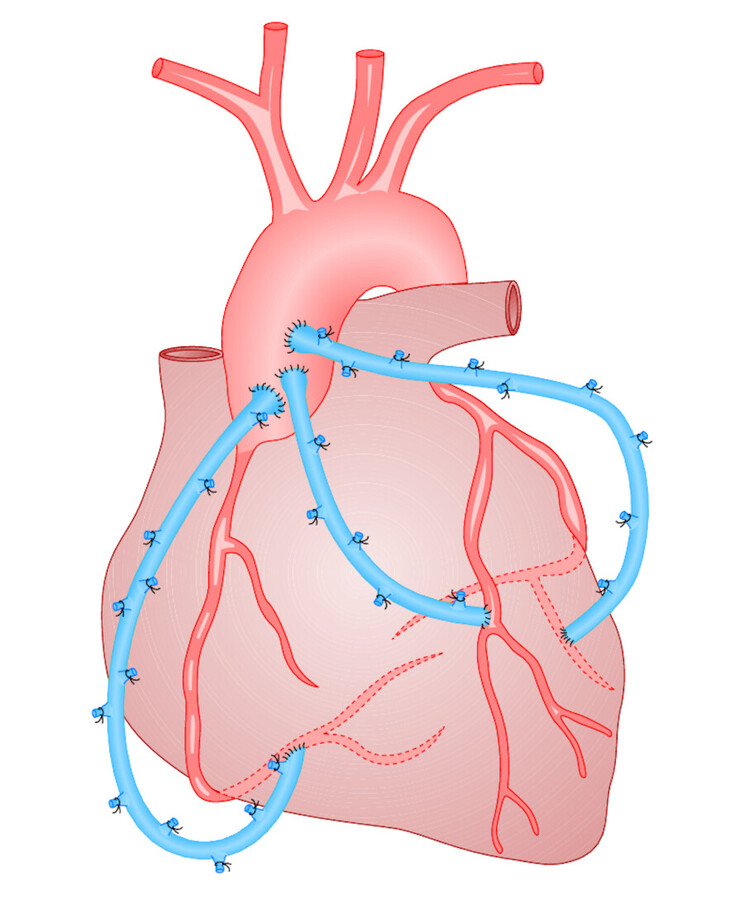 Aortokoronarer Venenbypass. Dargestellt ist ein 3-fach-Bypass, der die Stenosen in den Herzkranzgefäßen überbrückt. Die Ligaturen am Venenbypass entsprechen den abgebundenen Seitenästen der V. saphena