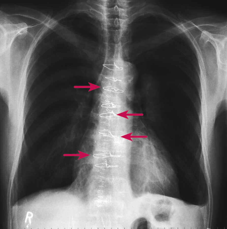 Thoraxinstabilität. Wenn der Brustkorb nur einseitig und unkontrolliert belastet wird, besteht die Gefahr der Sternuminstabilität. Die auf dem Thorax-Röntgenbild sichtbaren Drahtcerclagen könnten sich