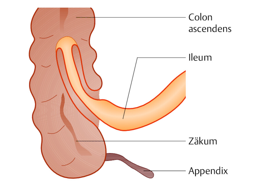 Invagination. Das terminale Ileum ist in den aufsteigenden Dickdarm eingestülpt.